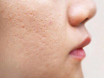 Close up of a woman's face with acne scars