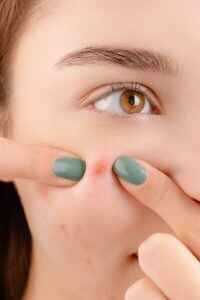 Should You Pop Your Pimples
