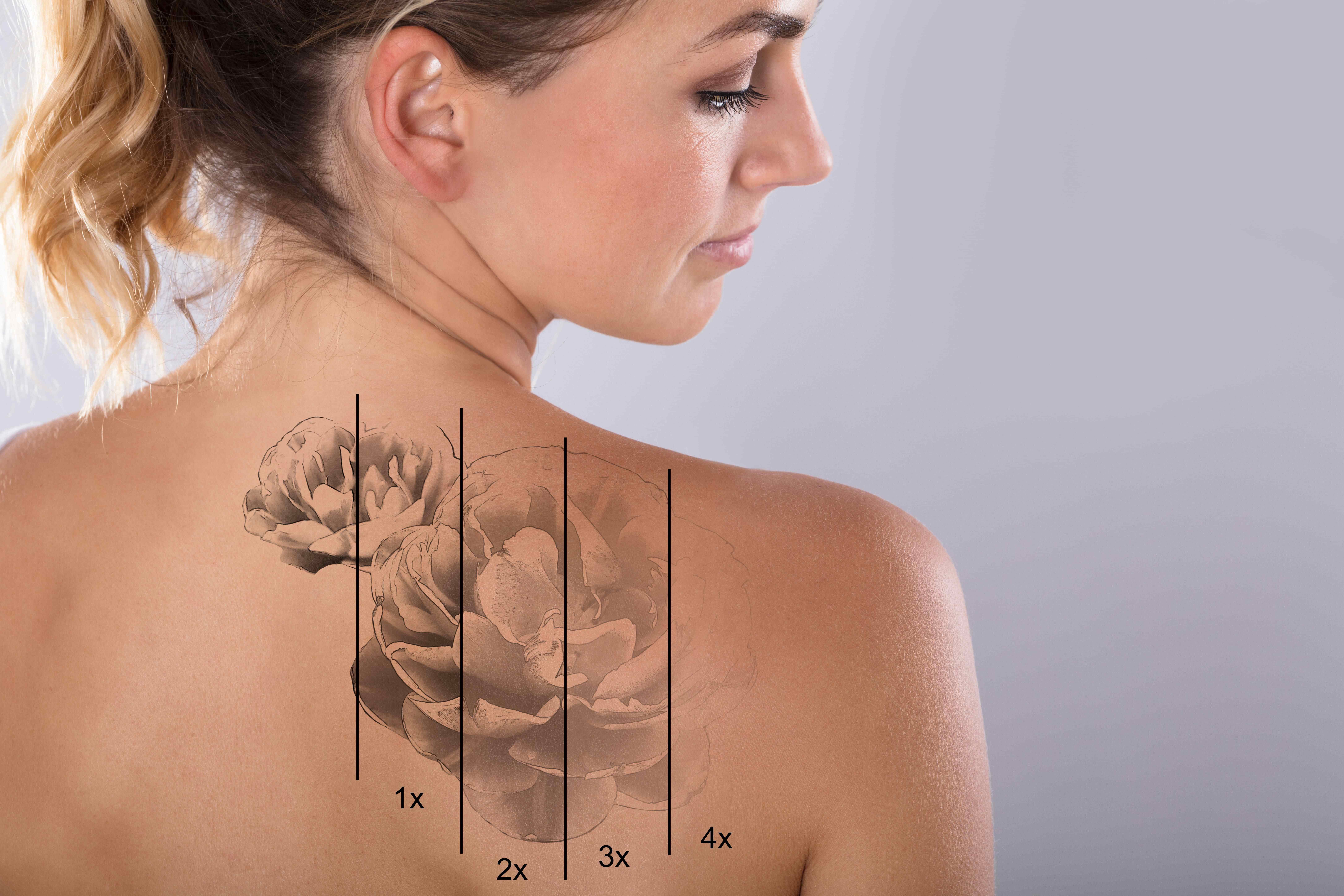 Will my tattoo be completely gone after laser treatments  Inkfree MD