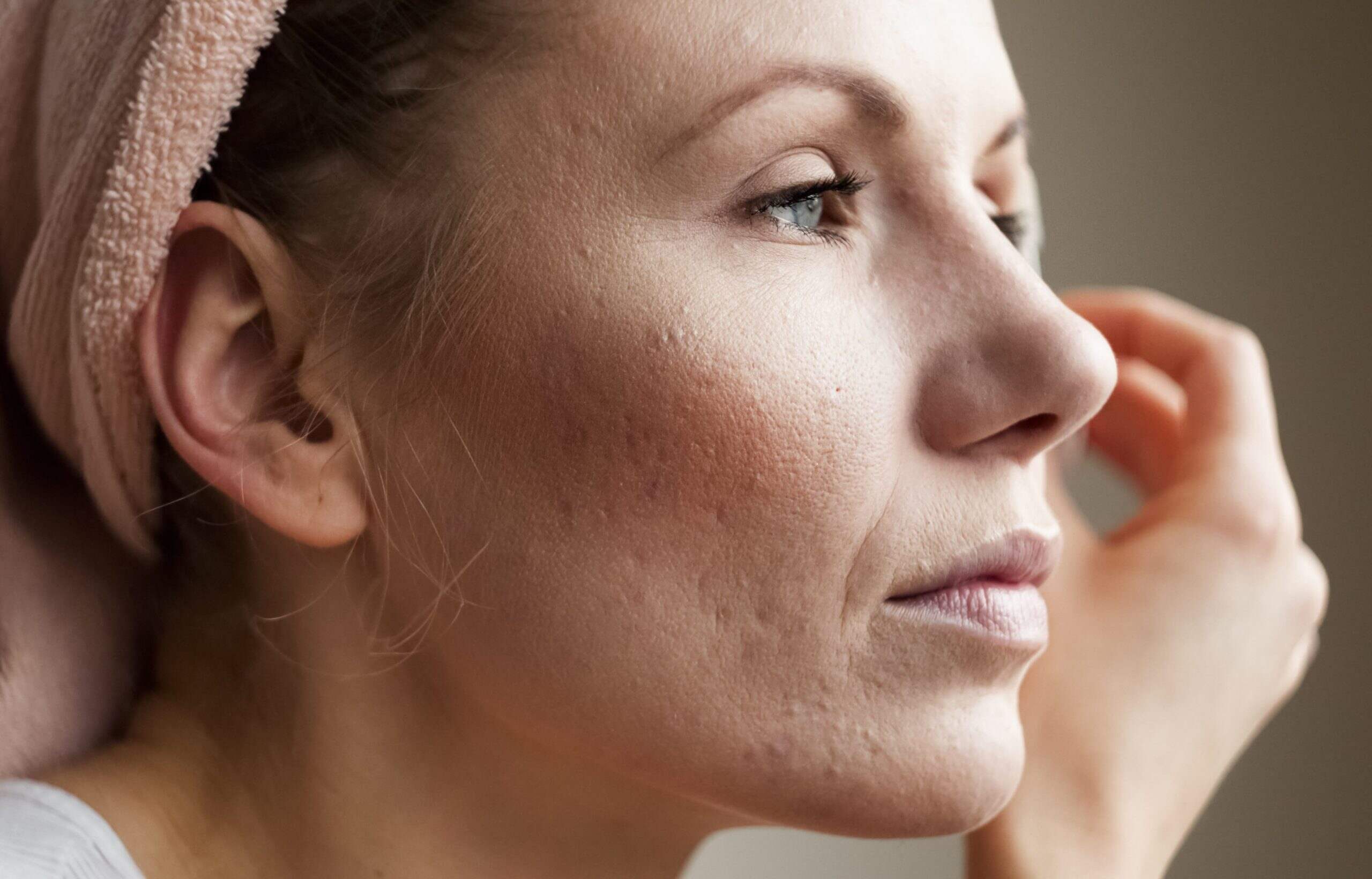 Laser and Light Treatments for Acne 