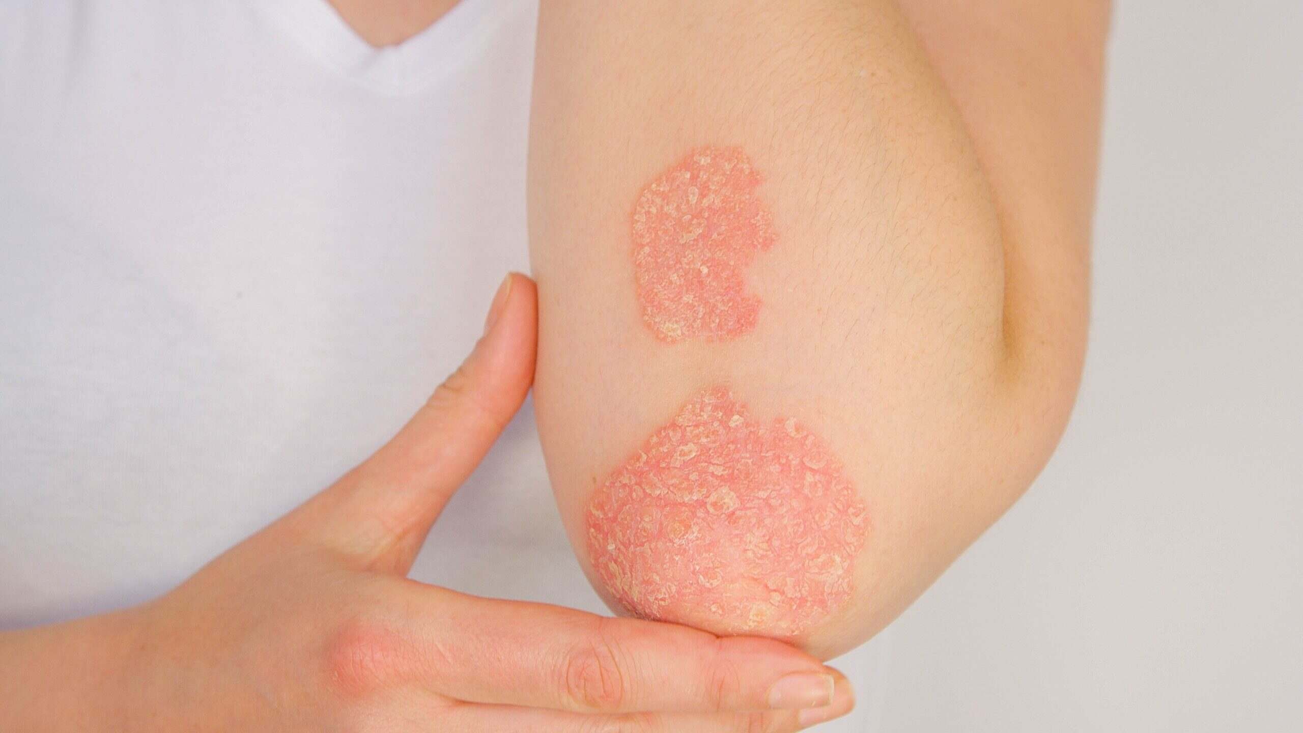 before and after laser treatment for psoriasis