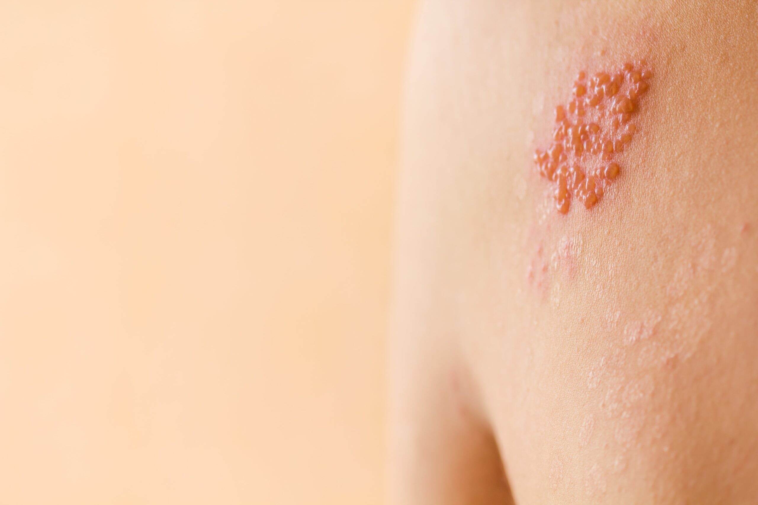 Shingles Symptoms & Treatment - Schweiger Dermatology Group