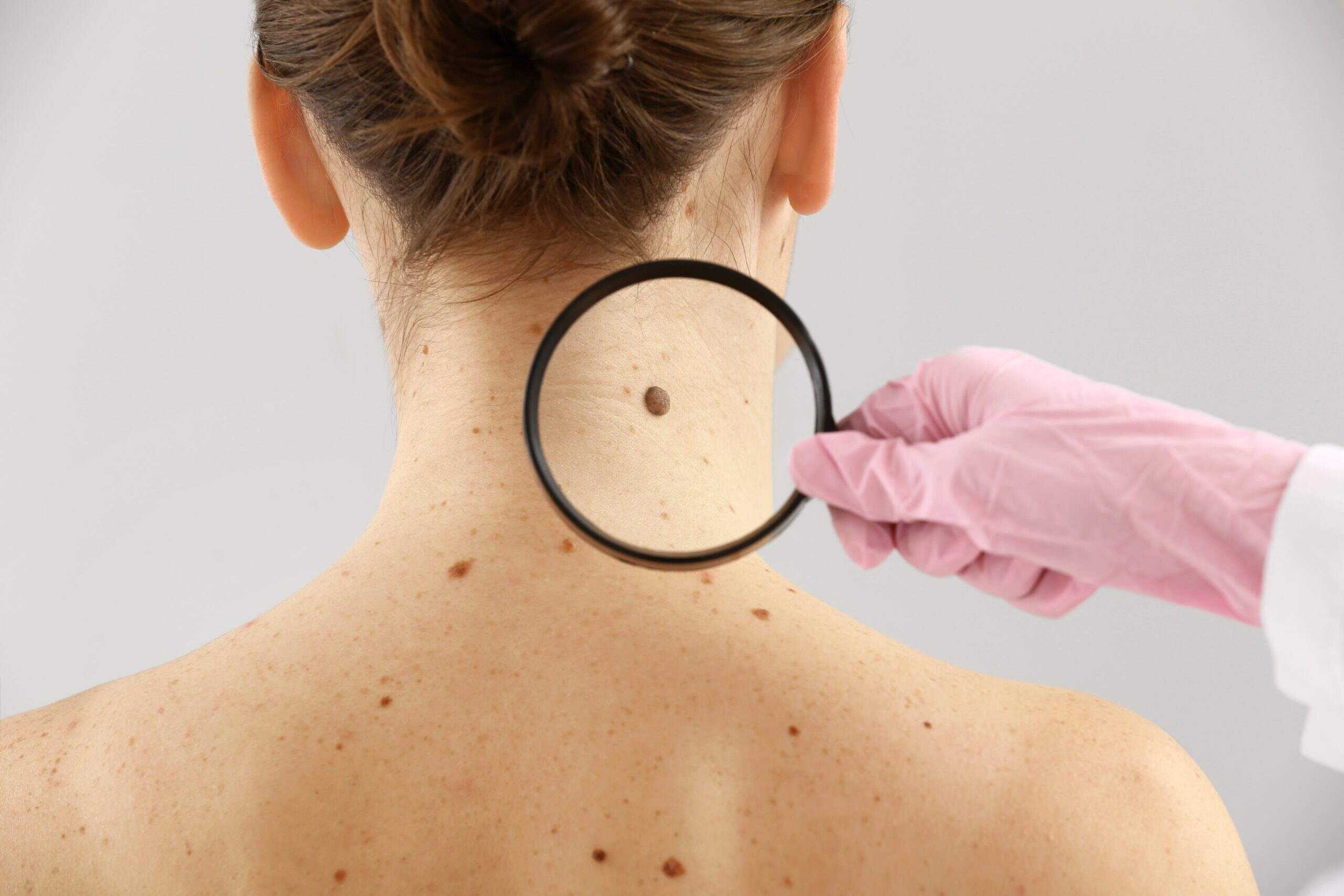 Skin Cancer Screening