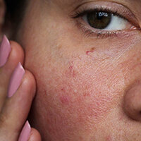 diminish-broken-facial-capillaries