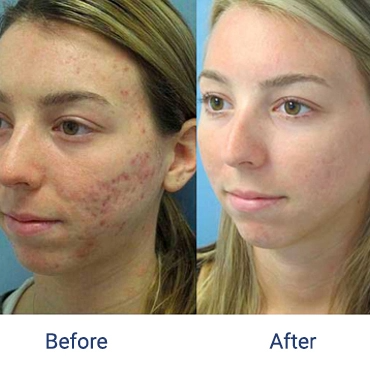 Before and after photos of a patient who underwent acne scar treatments at Schweiger Dermatology Group