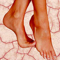 How to Care for Dry, Cracked Heels