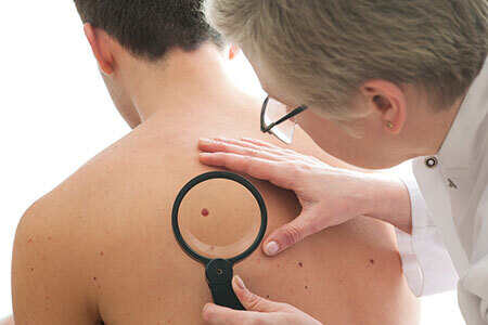 Dermatologist screening for skin cancer