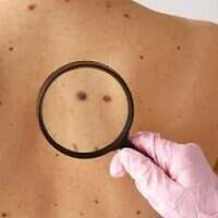 Poor candidates for surgery, elderly patients may consider SRT for skin cancer